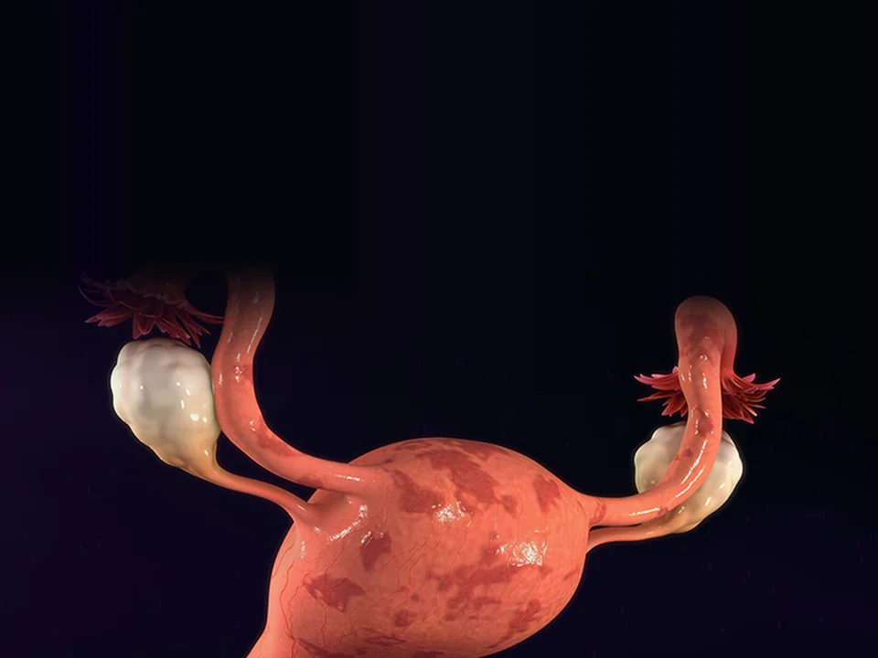 Chocolate Cyst