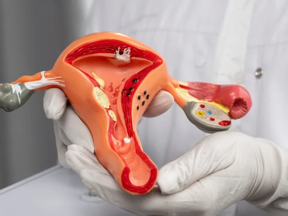 Fibroid Surgery